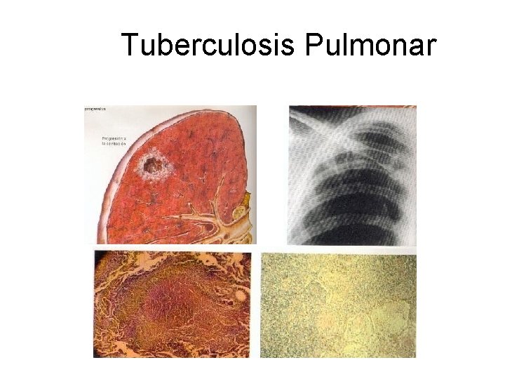 Tuberculosis Pulmonar 