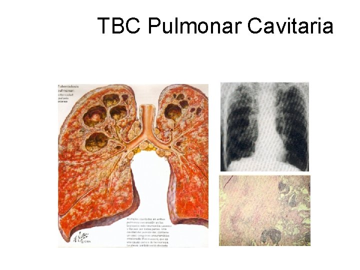 TBC Pulmonar Cavitaria 