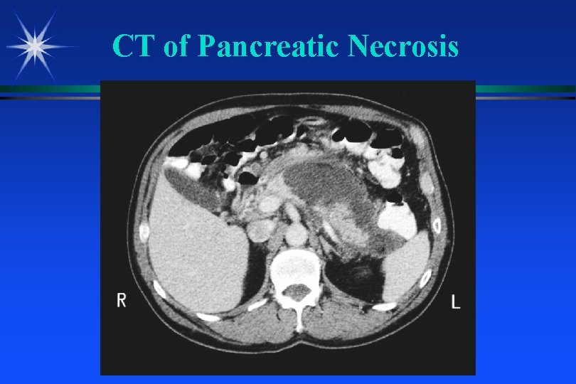 CT of Pancreatic Necrosis 