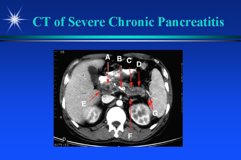 CT of Severe Chronic Pancreatitis 