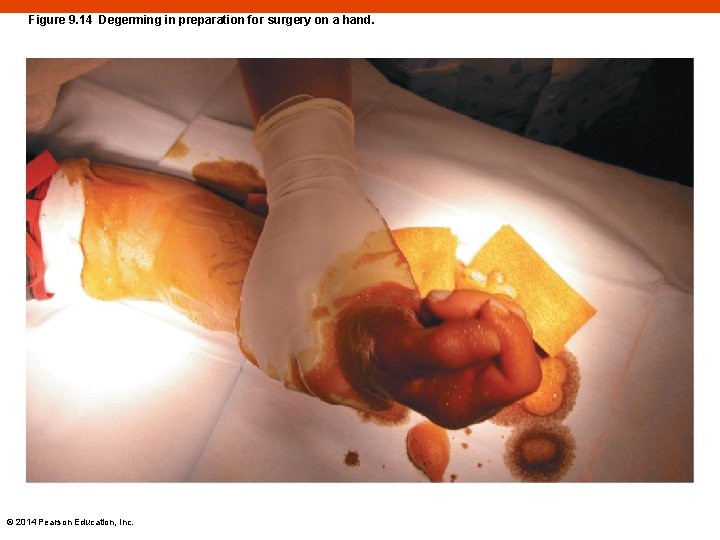 Figure 9. 14 Degerming in preparation for surgery on a hand. © 2014 Pearson