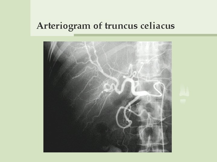 Arteriogram of truncus celiacus 