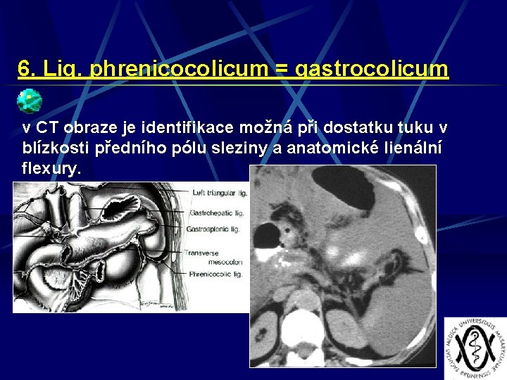 6. Lig. phrenicocolicum = gastrocolicum v CT obraze je identifikace možná při dostatku tuku