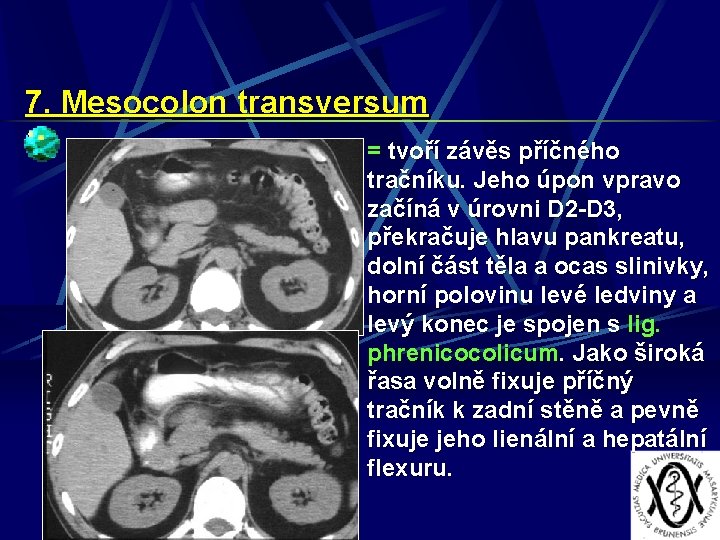 7. Mesocolon transversum = tvoří závěs příčného tračníku. Jeho úpon vpravo začíná v úrovni