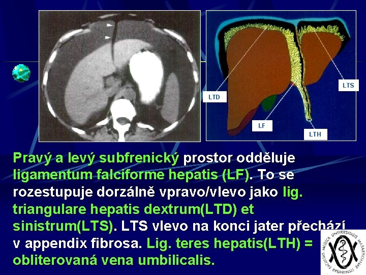 LTS LTD LF LTH Pravý a levý subfrenický prostor odděluje ligamentum falciforme hepatis (LF).