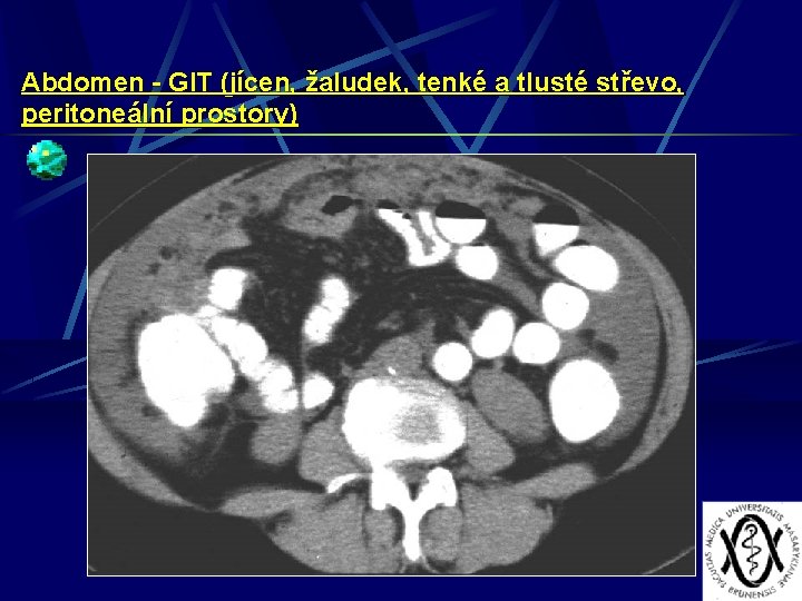 Abdomen - GIT (jícen, žaludek, tenké a tlusté střevo, peritoneální prostory) 