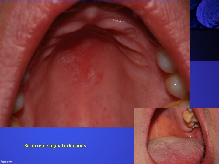 Recurrent vaginal infections 