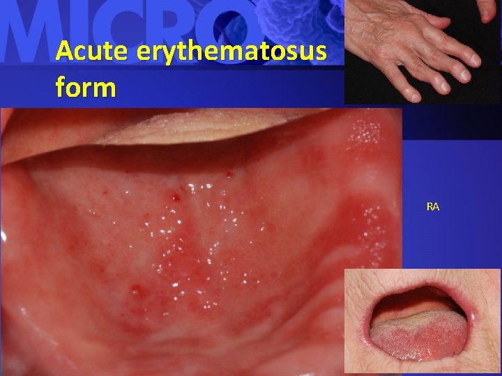 Acute erythematosus form RA 