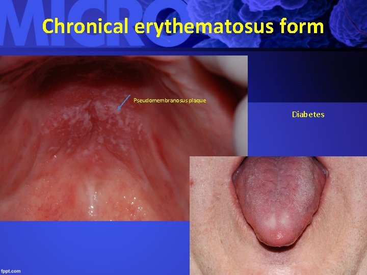 Chronical erythematosus form Pseudomembranosus plaque Diabetes 