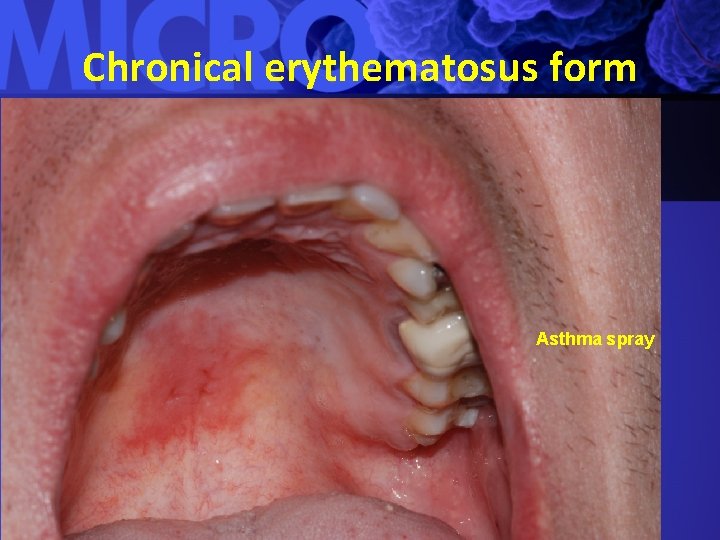 Chronical erythematosus form Asthma spray 