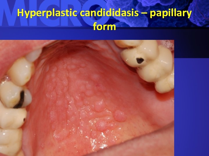 Hyperplastic candididasis – papillary form 