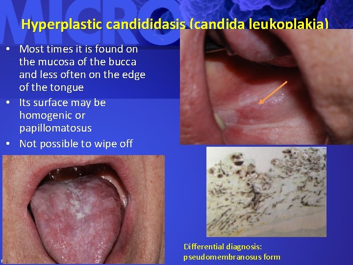 Hyperplastic candididasis (candida leukoplakia) • Most times it is found on the mucosa of