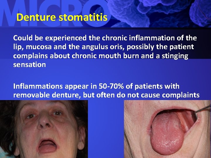 Denture stomatitis Could be experienced the chronic inflammation of the lip, mucosa and the