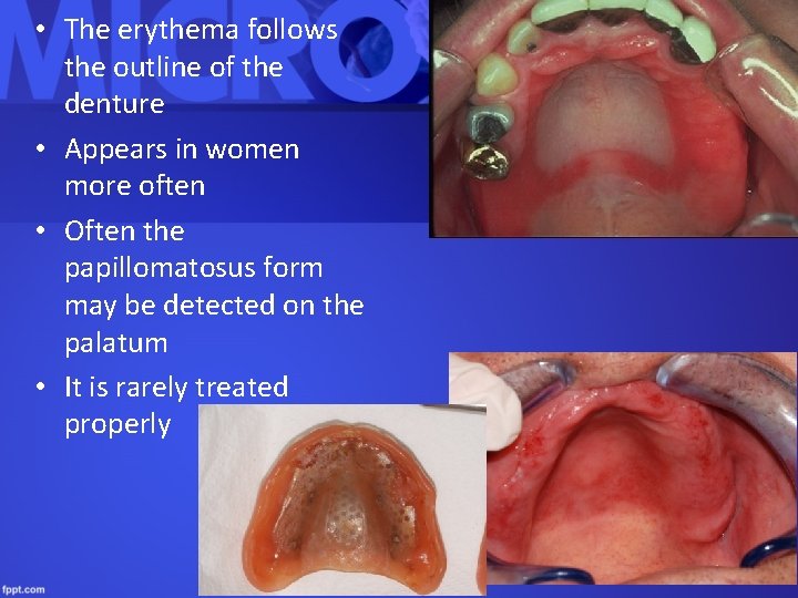  • The erythema follows the outline of the denture • Appears in women