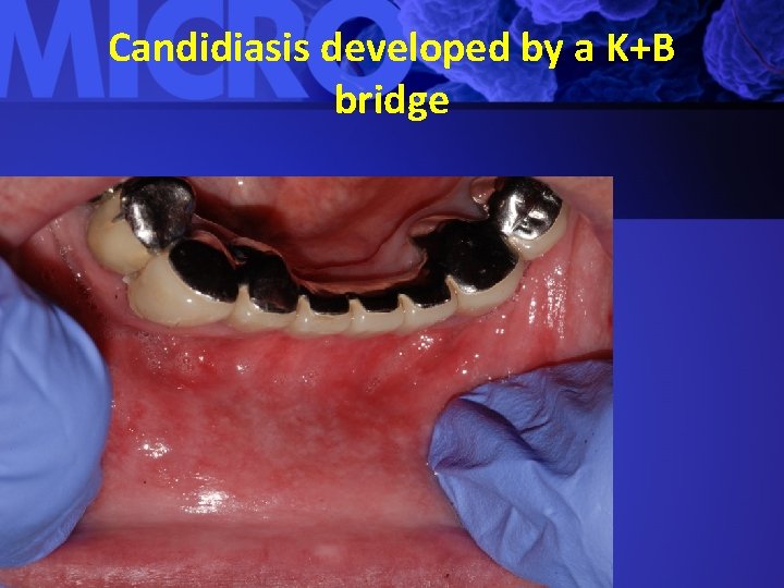 Candidiasis developed by a K+B bridge 