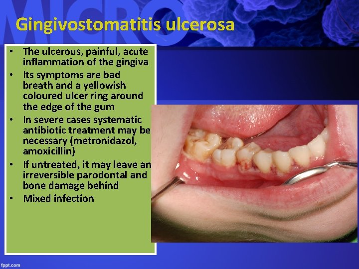 Gingivostomatitis ulcerosa • The ulcerous, painful, acute inflammation of the gingiva • Its symptoms