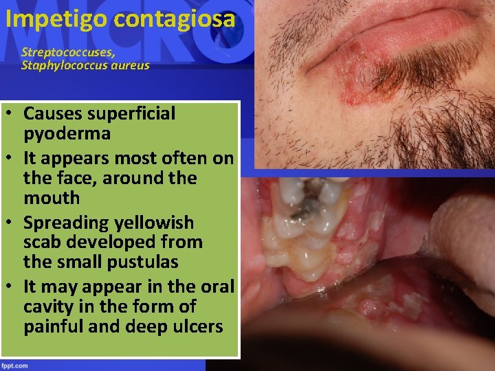 Impetigo contagiosa Streptococcuses, Staphylococcus aureus • Causes superficial pyoderma • It appears most often