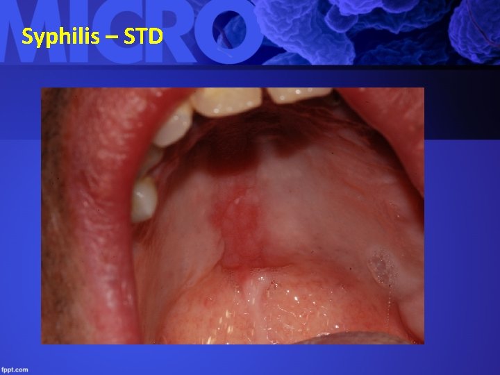 Syphilis – STD 