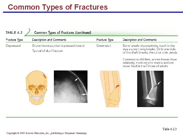 Common Types of Fractures Table 6. 2. 3 Copyright © 2004 Pearson Education, Inc.