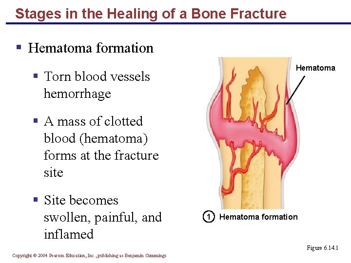 Stages in the Healing of a Bone Fracture § Hematoma formation Hematoma § Torn