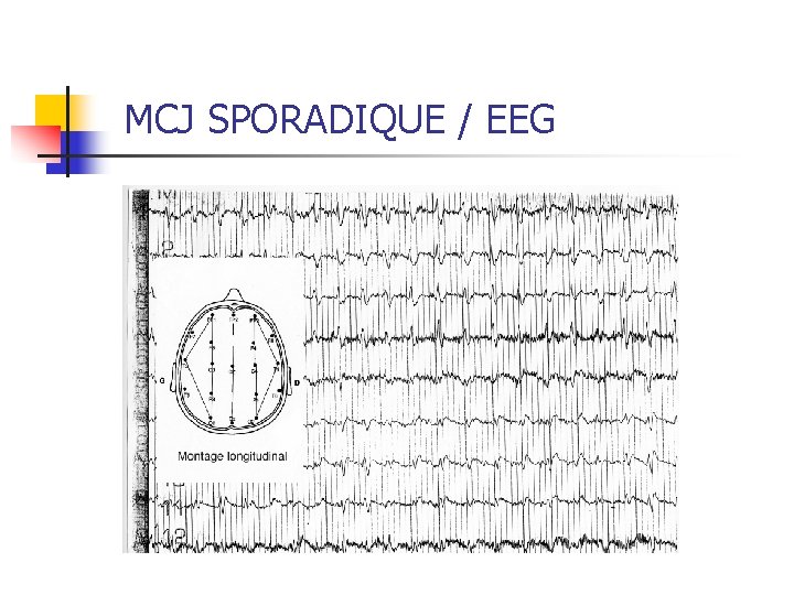 MCJ SPORADIQUE / EEG 