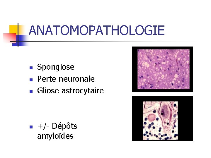 ANATOMOPATHOLOGIE n n Spongiose Perte neuronale Gliose astrocytaire +/- Dépôts amyloïdes 