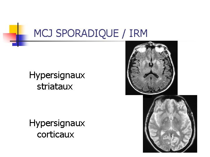 MCJ SPORADIQUE / IRM Hypersignaux striataux Hypersignaux corticaux 