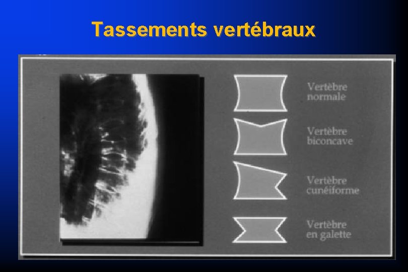 Tassements vertébraux 