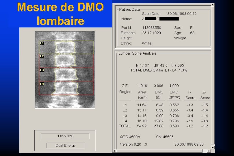 Mesure de DMO lombaire 