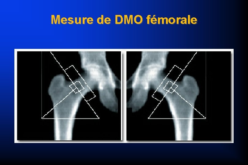 Mesure de DMO fémorale 