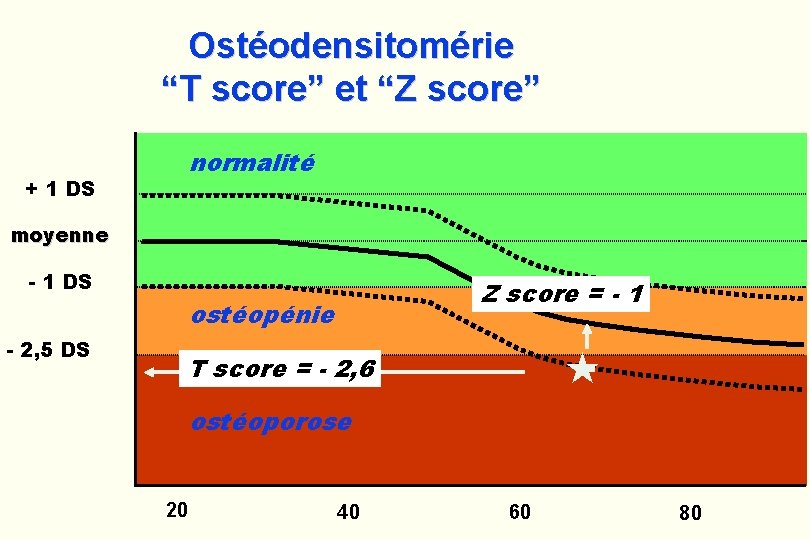 Ostéodensitomérie “T score” et “Z score” normalité + 1 DS moyenne - 1 DS