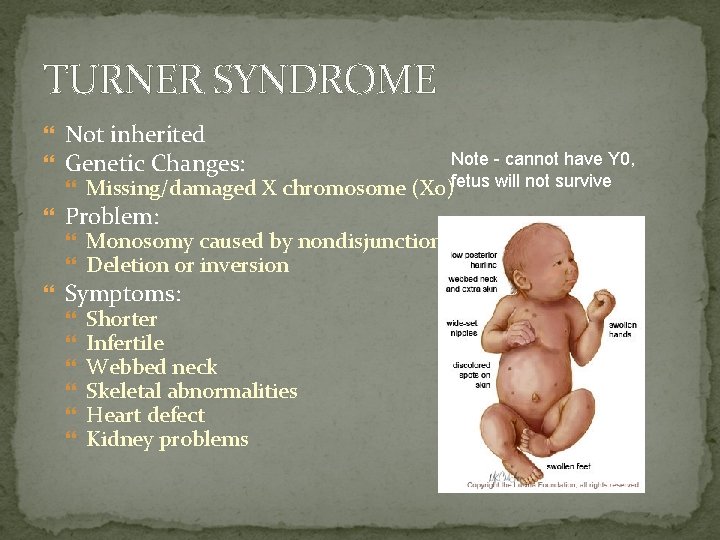 TURNER SYNDROME Not inherited Genetic Changes: Missing/damaged X chromosome Problem: Note - cannot have