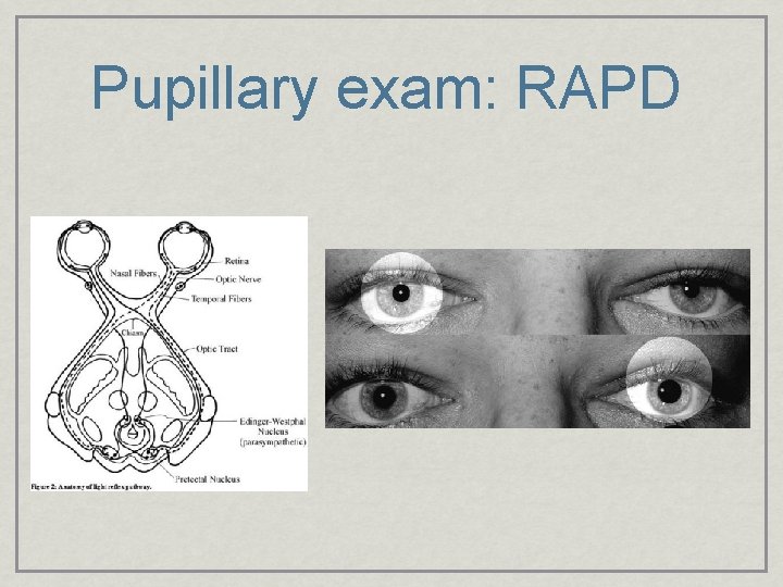 Pupillary exam: RAPD sft. jpg 