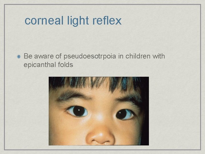 corneal light reflex Be aware of pseudoesotrpoia in children with epicanthal folds 