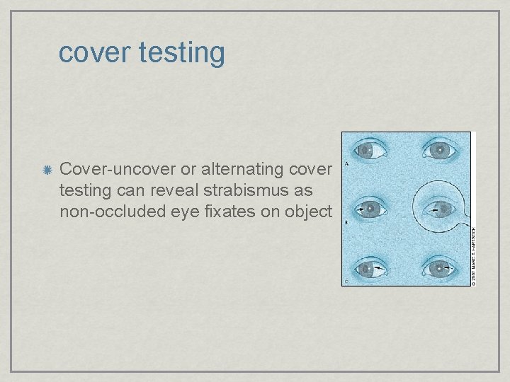 cover testing Cover-uncover or alternating cover testing can reveal strabismus as non-occluded eye fixates