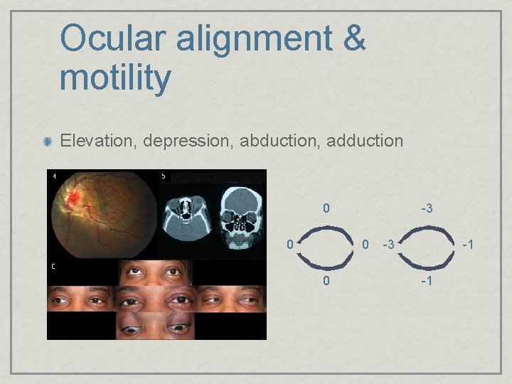 Ocular alignment & motility Elevation, depression, abduction, adduction 0 0 -3 -1 -1 