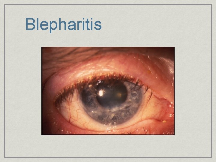 Blepharitis 