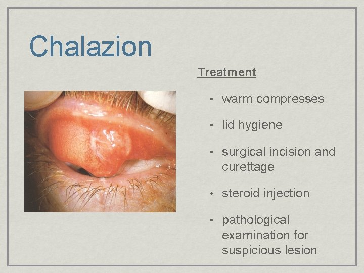 Chalazion Treatment • warm compresses • lid hygiene • surgical incision and curettage •
