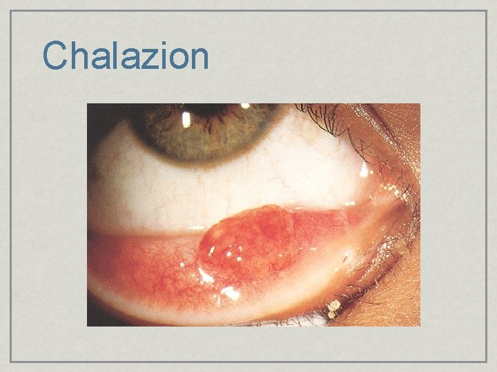 Chalazion 