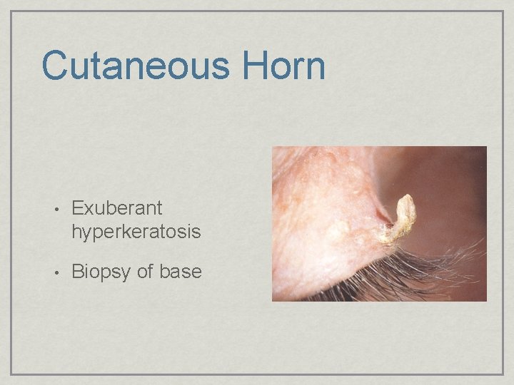 Cutaneous Horn • Exuberant hyperkeratosis • Biopsy of base 