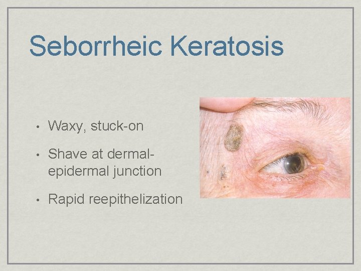 Seborrheic Keratosis • Waxy, stuck-on • Shave at dermalepidermal junction • Rapid reepithelization 