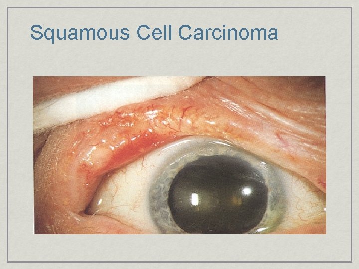 Squamous Cell Carcinoma 