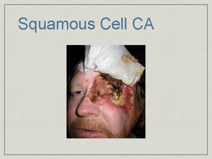 Squamous Cell CA 