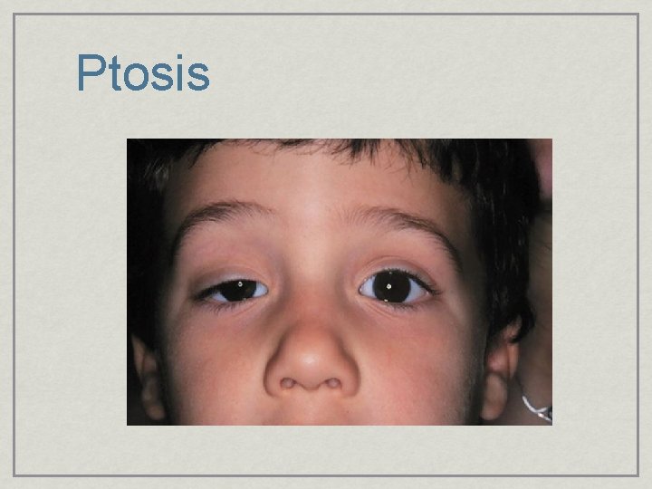 Ptosis 