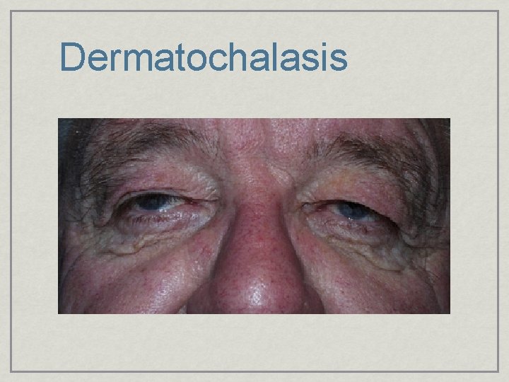Dermatochalasis 