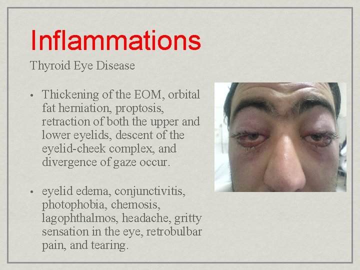 Inflammations Thyroid Eye Disease • Thickening of the EOM, orbital fat herniation, proptosis, retraction