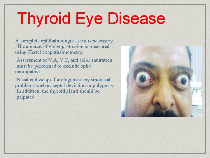 Thyroid Eye Disease A complete ophthalmologic exam is necessary. The amount of globe protrusion