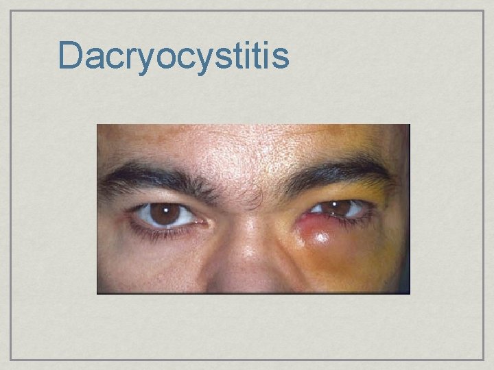 Dacryocystitis 