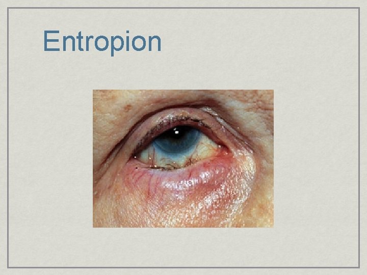 Entropion 