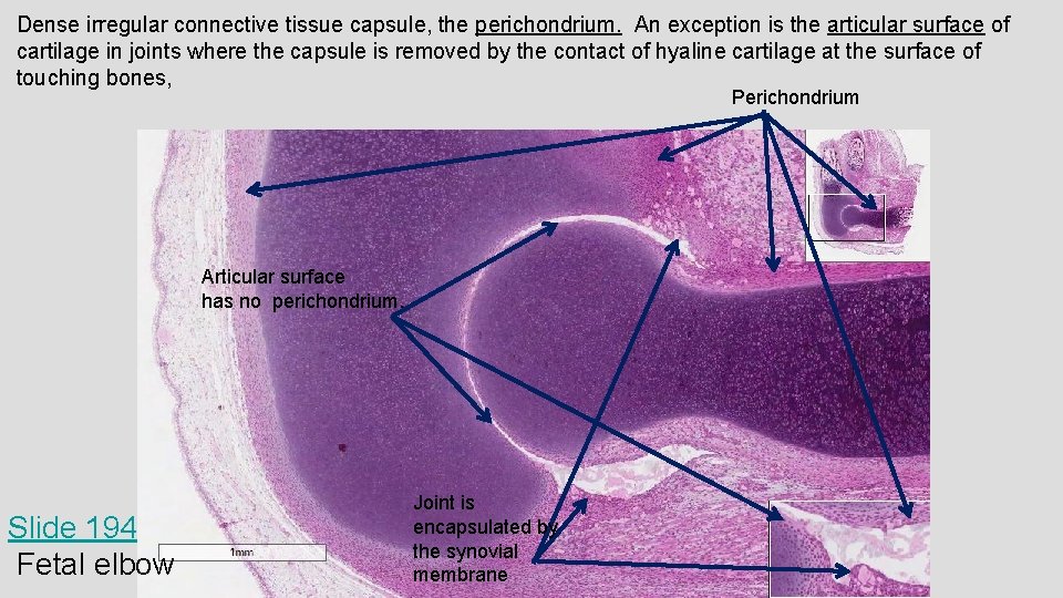 Dense irregular connective tissue capsule, the perichondrium. An exception is the articular surface of Dense irregular connective tissue capsule, the perichondrium. An exception is the articular surface of